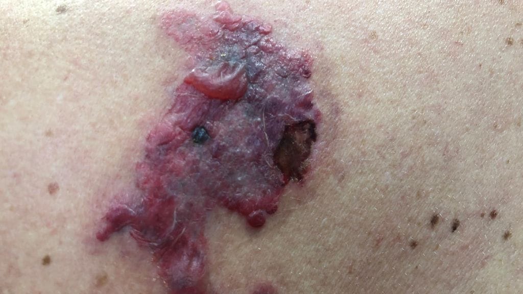 Tatuoinnin jälkeen iholle voi ilmestyä vesirakkuloita