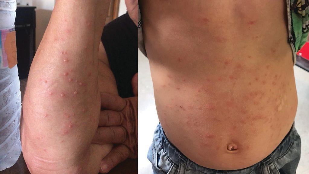 Lintukirppu sai perheen ihon kutiamaan.