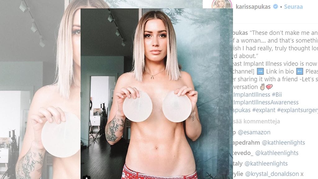 Youtube-videoistaan tunnettu Karissa Pukas kärsi vuosia erikoisista oireista. Vasta myöhemmin syylliseksi paljastuovat hänen silikoni-implanttinsa. Kuvan lähde Instagram