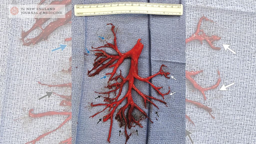 36-vuotias mies yski ulos härvinaisen erikoisen verihyytymän.
Kuvan lähde NEJM.org
