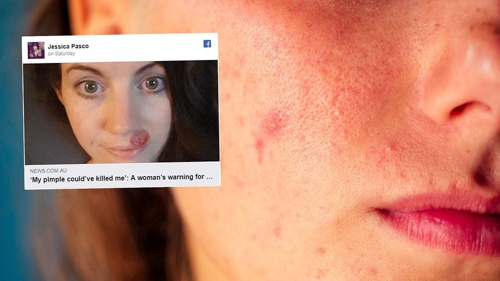 Nenän alle ilmestynyt "finni" olikin merkki ihon tyvisolusyövästä.