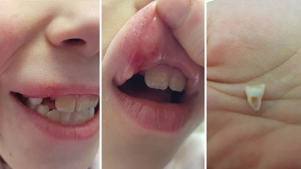 Klaara liukastui jäisellä koulun pihalla. maitohammas irtosi, mutta onneksi viereiset rautahampaat säilyivät ihan ehjinä.