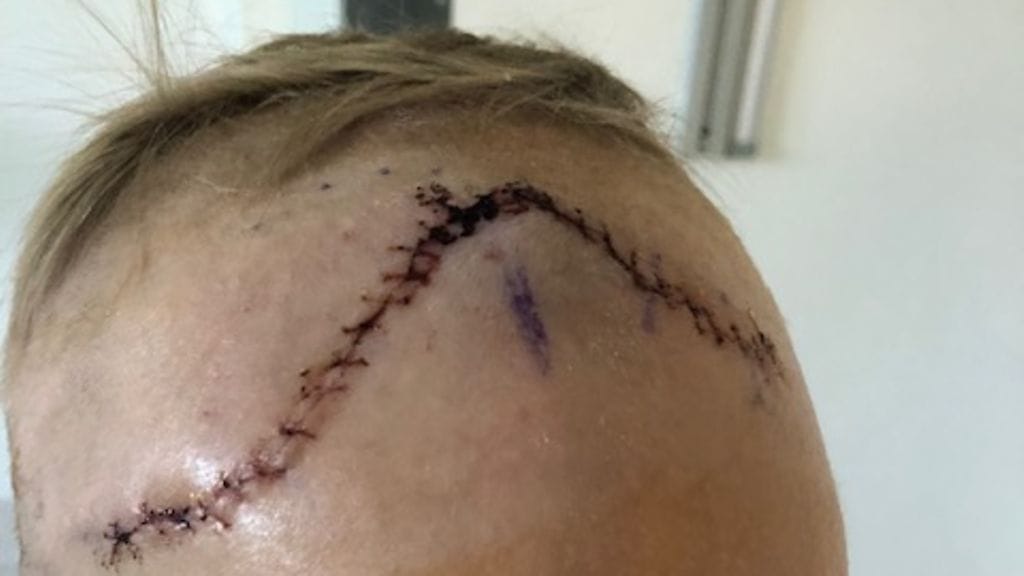 Kasperi Nieminen, aivokasvain