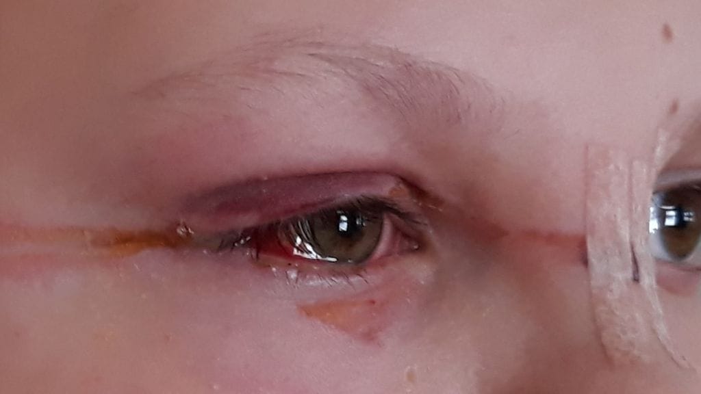 14-vuotias Mico Palomäki loukkasi silmänsä tapauksessa.