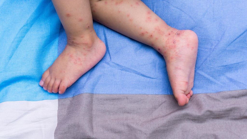 THL tiedottaa, että enterovirusta on nyt liikkeellä normaalia enemmän. Kuvituskuva.