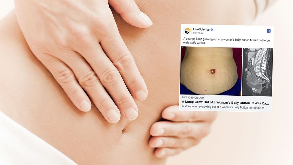 Munasarjasyöpä voi levitä napaan. Kuvituskuva Shutterstock, kuvakaappaus LiveScience/Facebook.