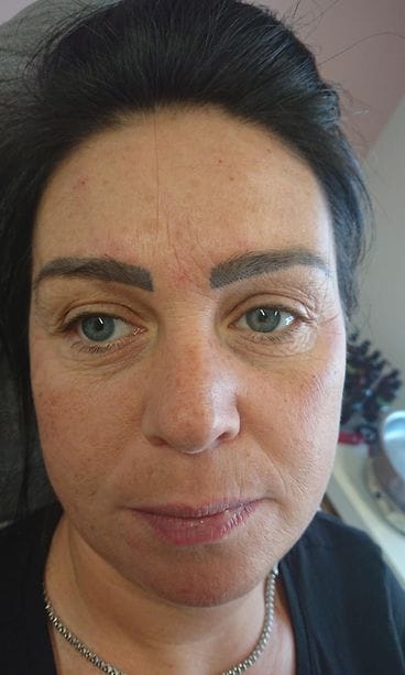 Botox-rikosepäily Vantaalla, epäilty 1