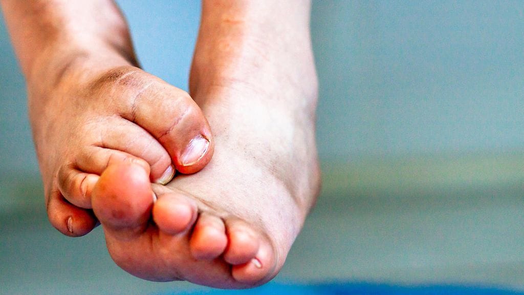 Trooppisilla alueilla viihtyvät hiekkakirput voivat aiheuttaa tungiaasin, jonka oireita ovat jalkoihin ilmestyneet mustuneet näppylät. Kuvituskuva.