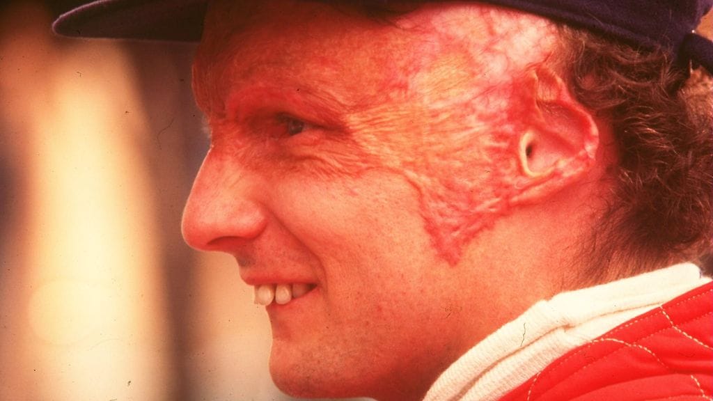 Niki Lauda selvisi vakavasta onnettomuudestaan hengissä ja palasi takaisin F1-huipulle.