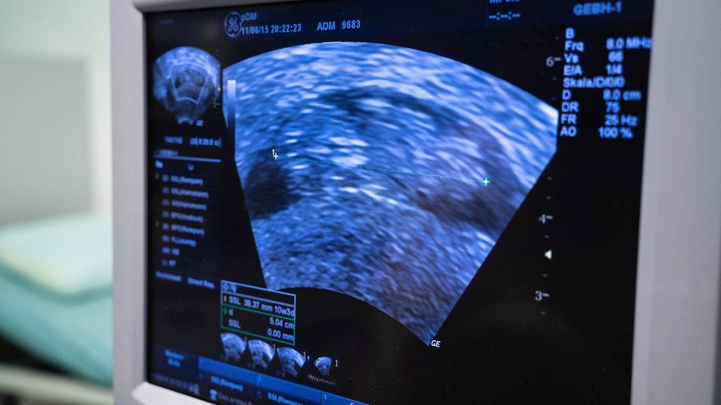 Belen Aguilera selasi Facebookia, kun hän tajusi tulleensa huijatuksi. Chilessä asuva Belen selaili julkaisuja, kun hän törmäsi tutunoloiseen ultraäänikuvaan. Kuvituskuva.