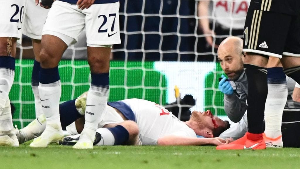 Belgialaistoppari Jan Vertonghen satutti päätään tiistaina Mestarien liigan välierässä.