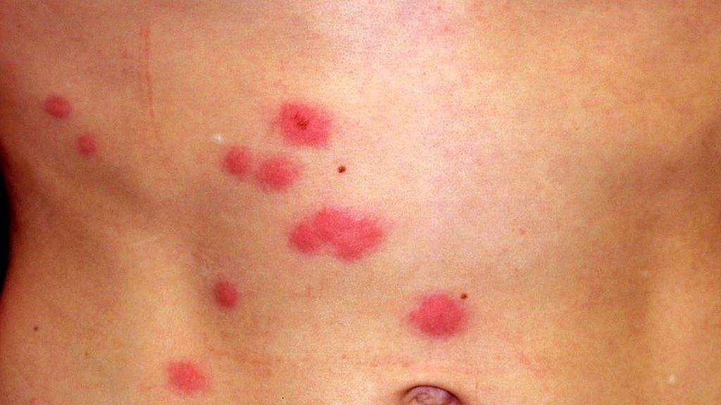 Lintukirpun puremia, kuva Raimo Suhonen