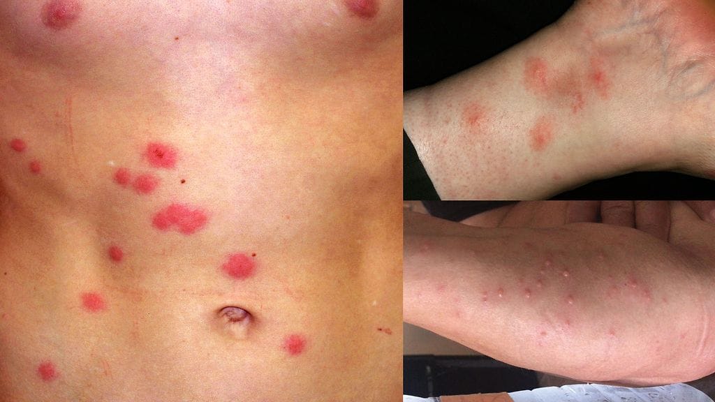 kaikilla kolmella ihmisellä on lintukirpun puremia.