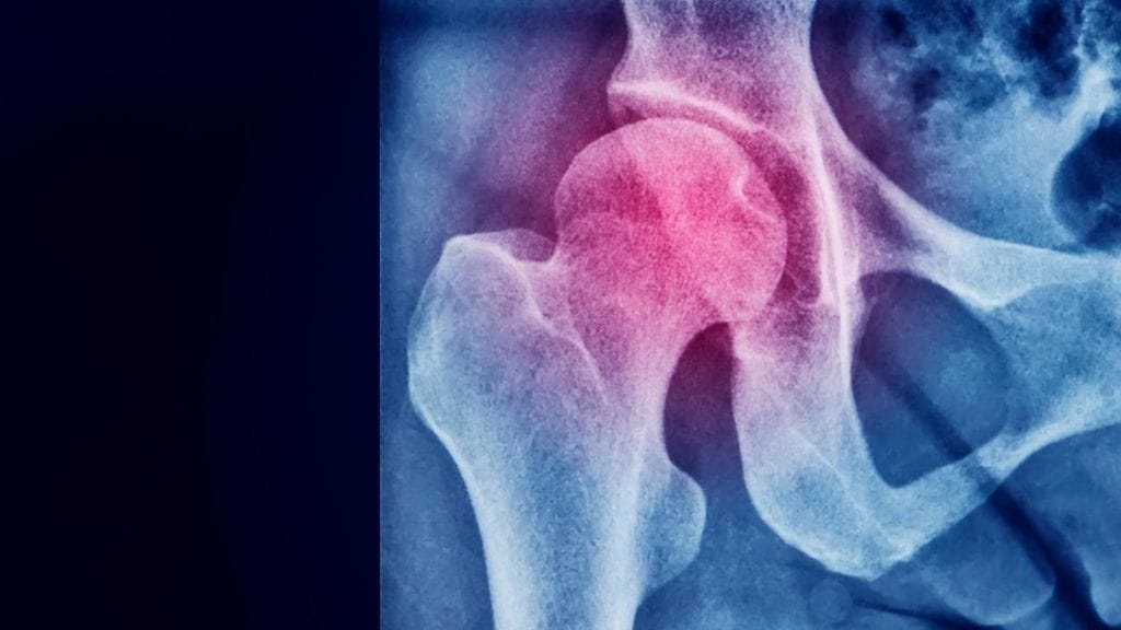 Osteopeniassa luun tiheys on heikentynyt. Tilaa pidetään osteoporoosin esiasteena. Kuvituskuva.