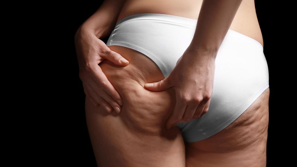 Selluliittia on jopa yhdeksällä naisella kymmenestä. Kuvituskuva.