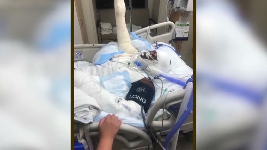 13-vuotias Miyah melkein kuoli kokeilemansa "tulihaasteen" vuoksi. Haasteessa henkilö sytyttää itsensä tuleen. Kuva CNN