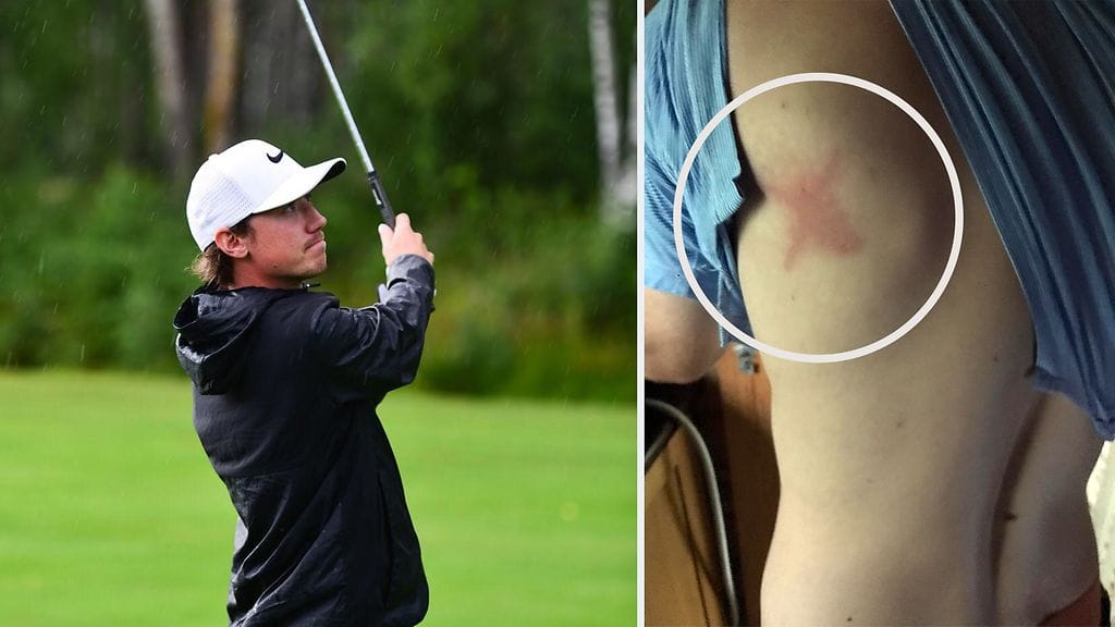 Benjamin, 25, sai salamaniskusta oudonmuotoisen jäljen selkäänsä.