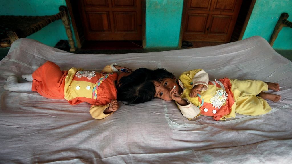 Kaksoset Safa ja Marwa kotonaan Pakistanissa ennen leikkausta helmikuussa 2018.