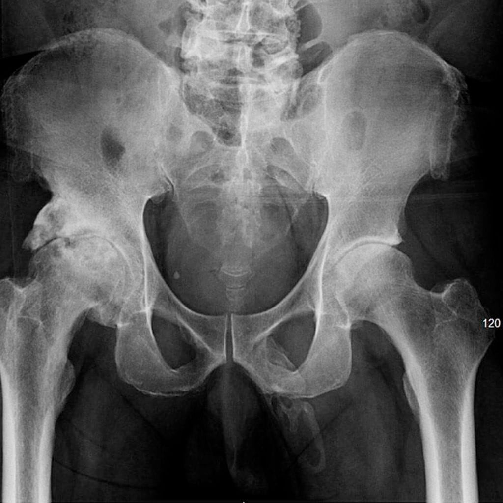 peniskuva uroplogy case reports