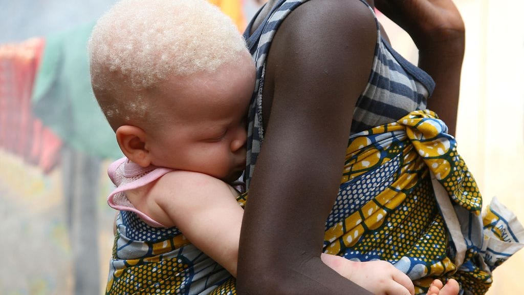 Albinismi on harvinainen ja monimuotoinen geneettinen tila, mihin liittyy pigmentin vähäisyydestä aiheutuva tavallista vaaleampi iho. Kuvan albiino lapsi matkasi siskonsa selässä Sierra Leonessa.