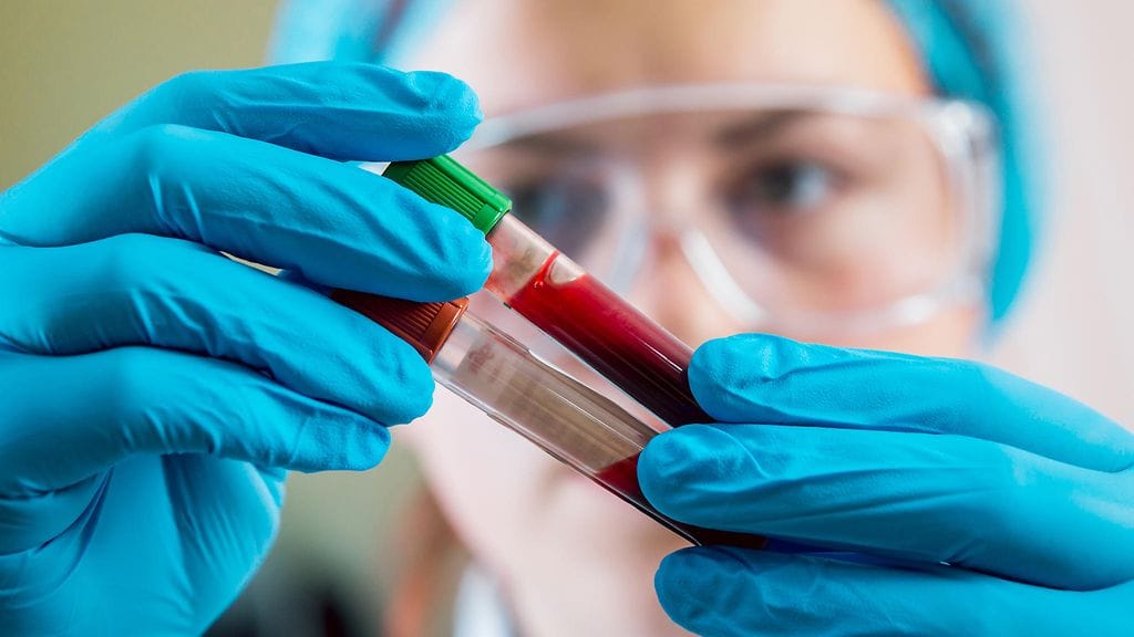 Verikokeesta ilmenevät biomarkkerit kertovat lähestyvän kuoleman riskistä. Kuvituskuva.