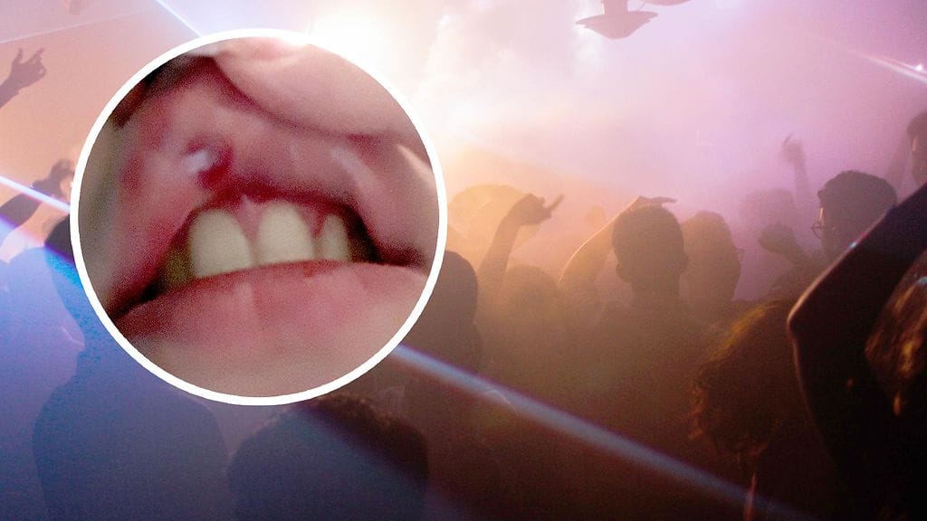 Annan näkyvät vammat jäivät pieniksi, mutta kivut ovat olleet kovat.