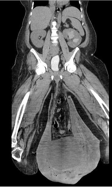 urology case reports kivespussit