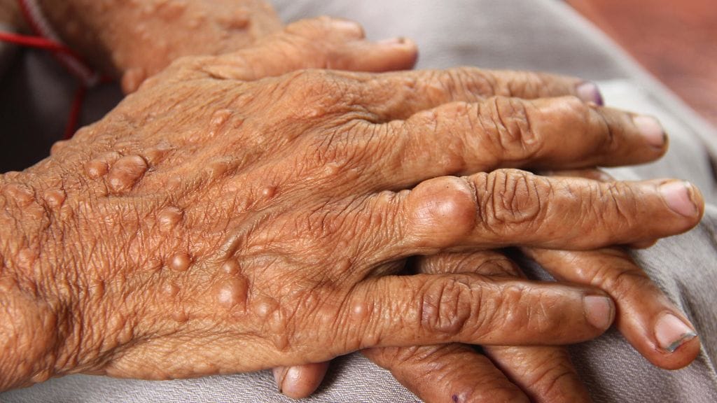 Intialaismiehellä on harvinainen geneettinen sairaus, jonka vuoksi hänen ihossaan on tuhansia kasvaimia.