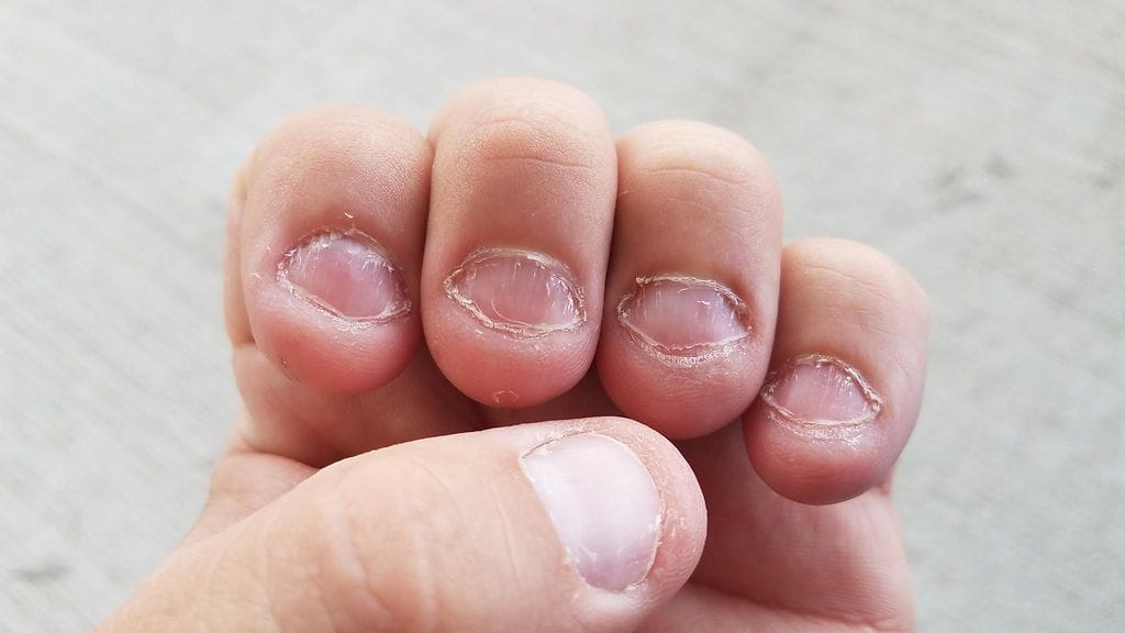 Skottimies pureskeli kynsiään, sai vakavan infektion ja joutui leikkaukseen.