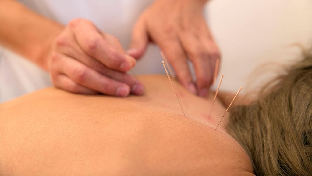 Akupunktio