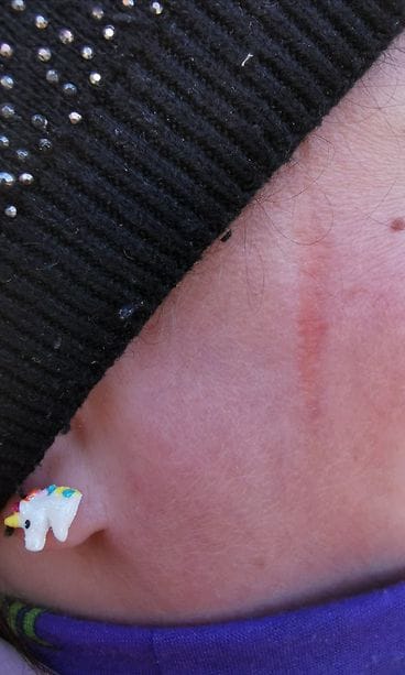 sirkku sektioarpi aikuinen