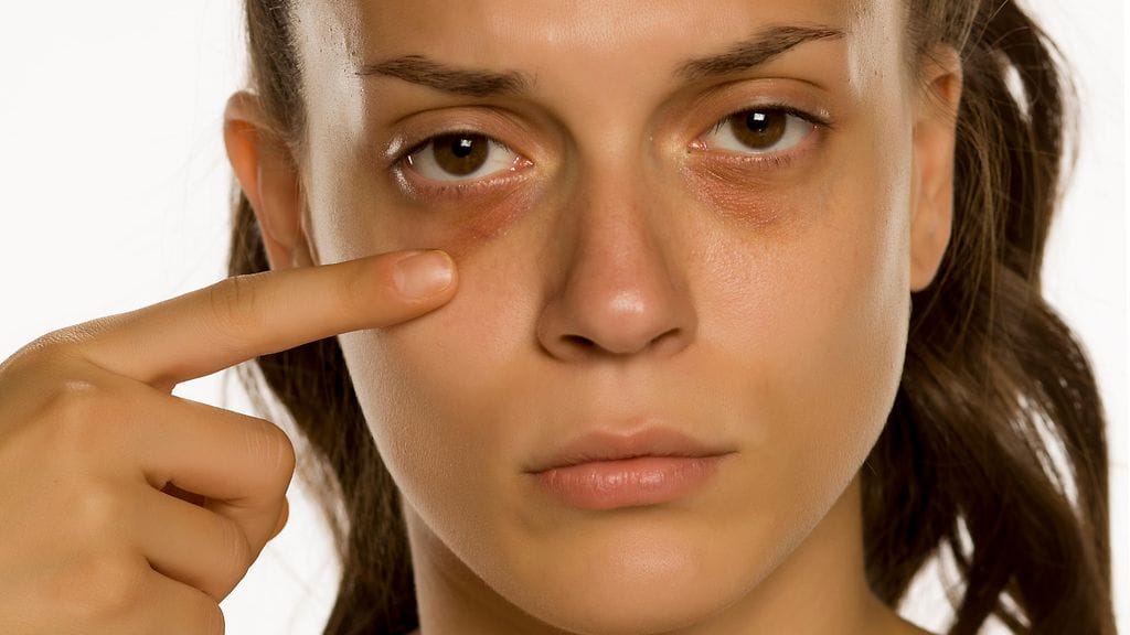 tummat silmänaluset