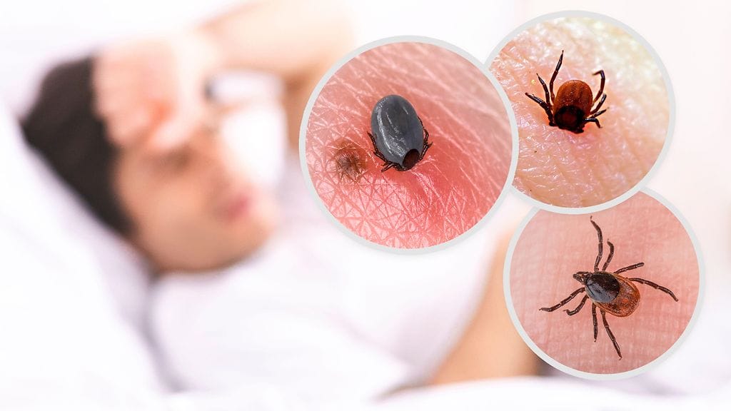 TBE-rokotetta otetaan omakustanteisesti myös alueilla, jotka eivät ole rokotusohjelman tai -suosituksen piirissä