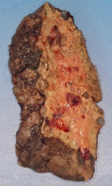Patient's COVID lung