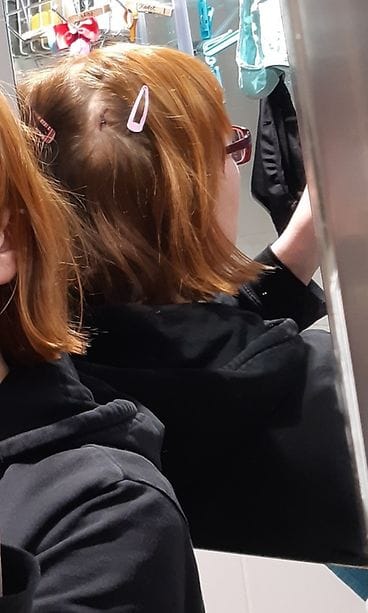 OMA: Haava, loukkaantuminen. EI KUVITUSKUVAKSI