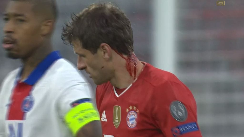 Bayern Münchenin Thomas Müller vuosi hurjan näköisesti verta PSG-ottelun toisella jaksolla.