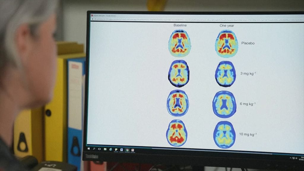 Alzheimer-lääke, aivotutkimus