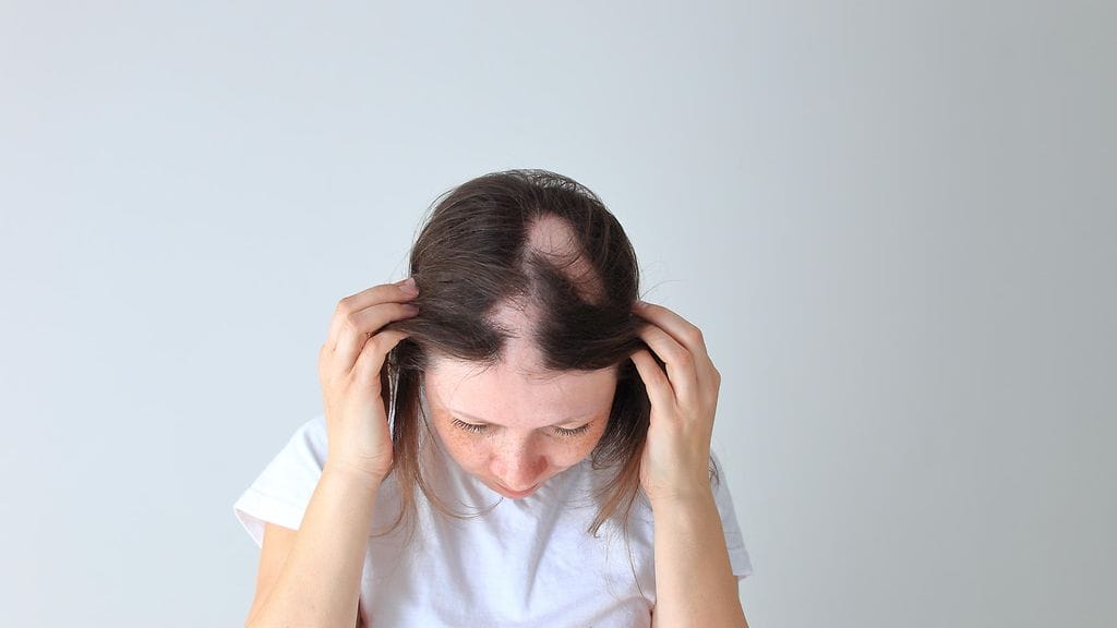 Lapsen päässä on kaljuja kohtia