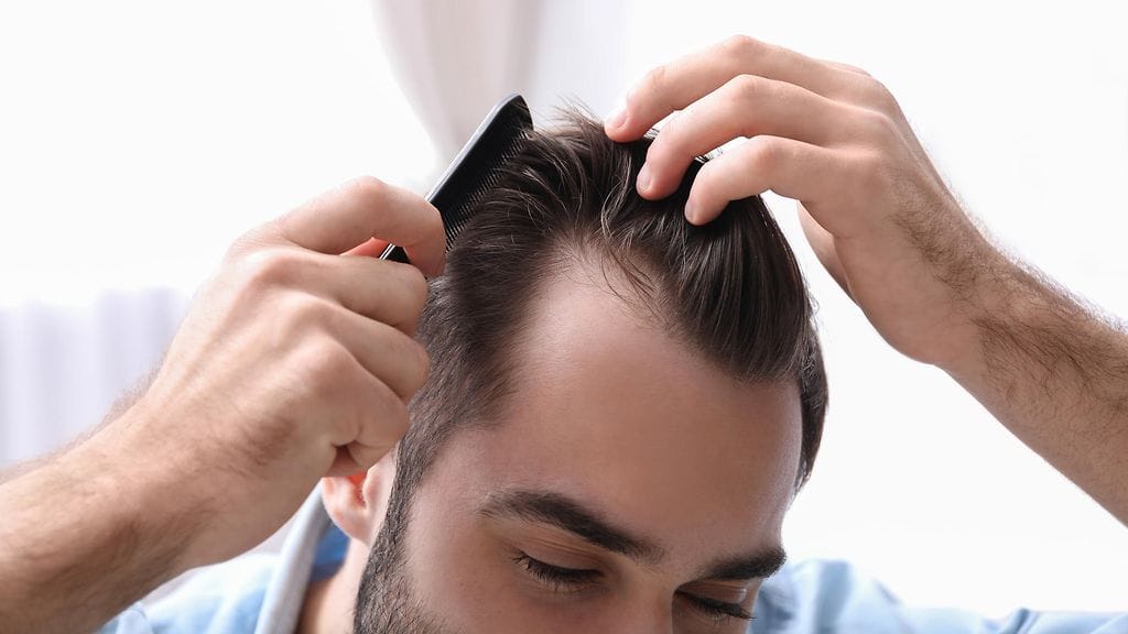 Jotkut miehet alkavat kaljuuntua jo ennen 20. ikävuotta. Kuvituskuva.