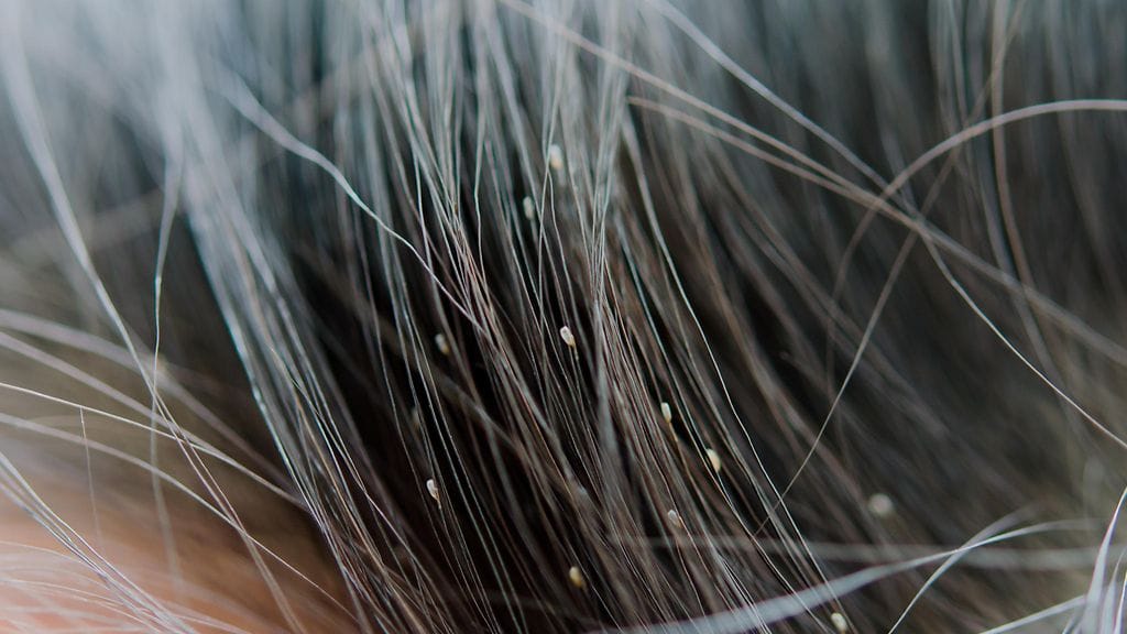 Vanhemman naisen päänahassa pesi satoja täitä. Kuvituskuva.