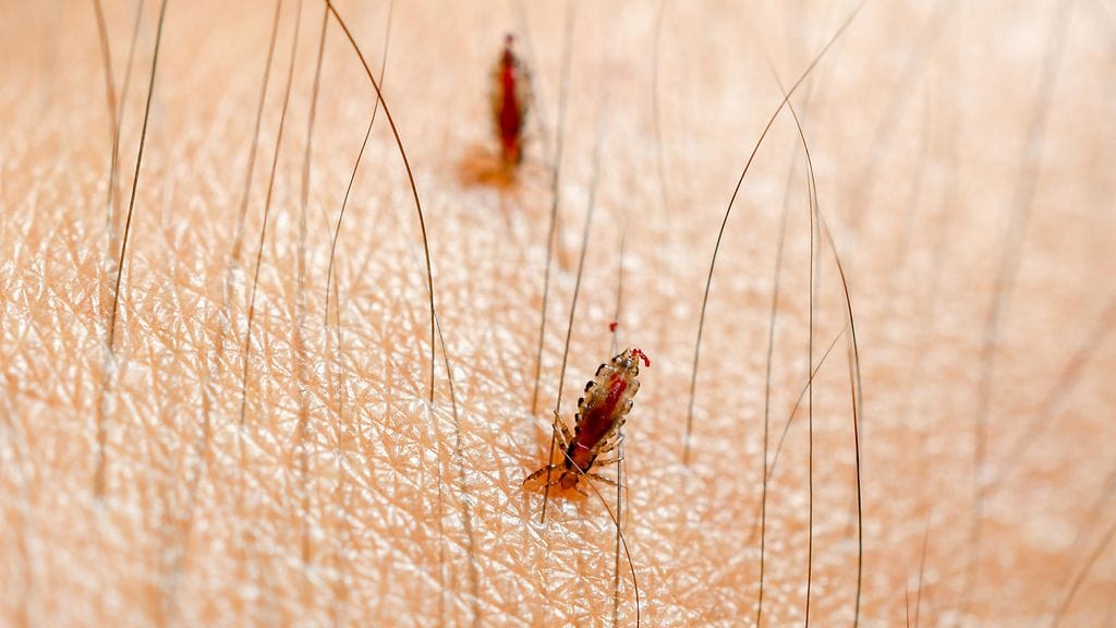 Täitä päänahassa