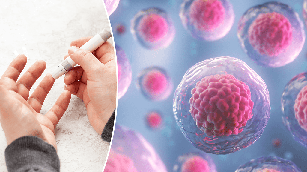 Kantasoluhoito näyttää parantaneen amerikkalaismiehen diabeteksen. Kuvituskuva.