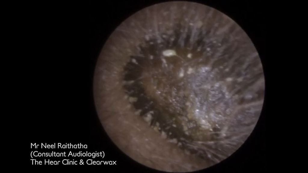 Raithathan vastaanotolle saapui potilas, jonka korvavahan määrä todella teki vaikutuksen.