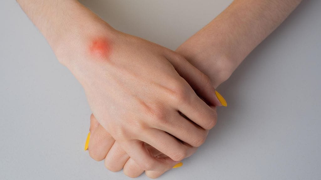 Ganglio kuvituskuvassa.