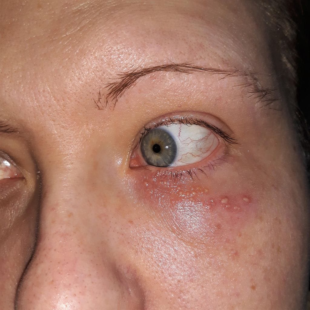 herpes silmässä