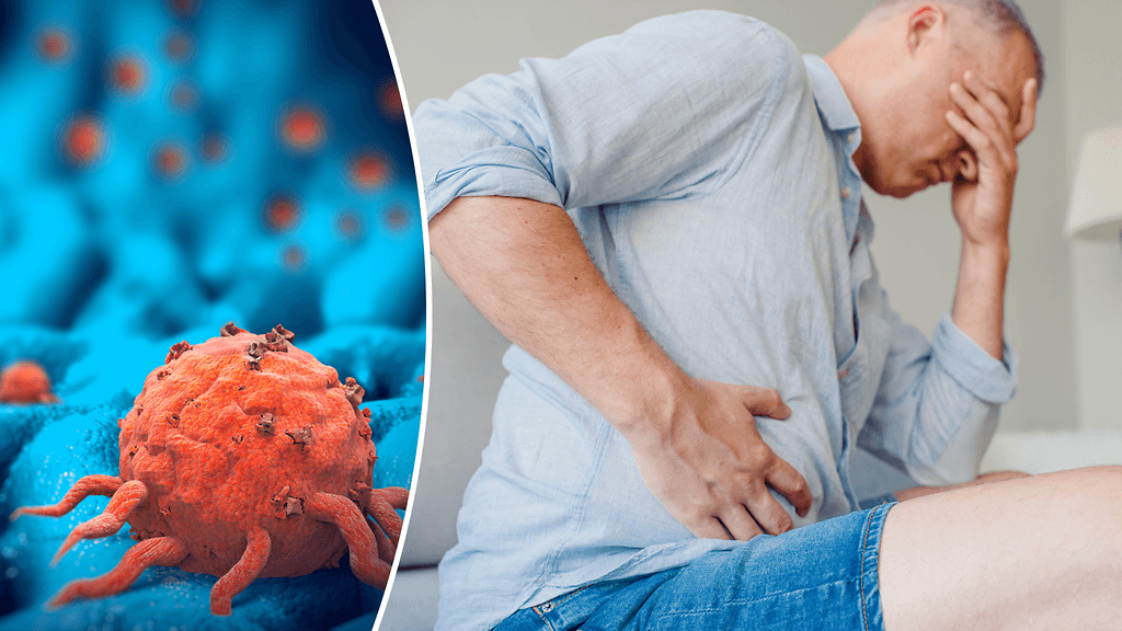 Haimasyövän tavallisimpia oireita ovat laihtuminen, ylävatsakipu, selkäkipu ja ihon muuttuminen keltaiseksi.