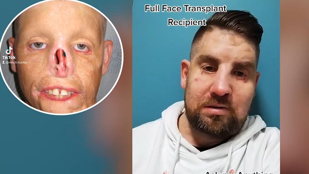 Mitch sai kasvosiirteen. Kuva KameraOne