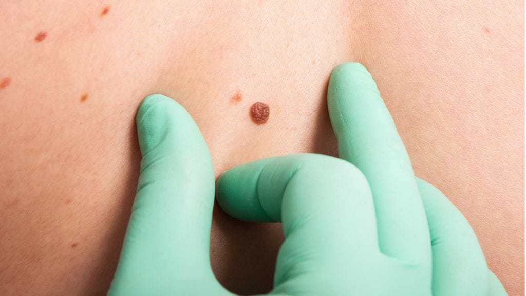 Luomiin, jotka ovat olleet iholla aina, voi myös kehittyä syöpä. Uusi luomi ei kuitenkaan automaattisesti merkitse syöpää. Kuvituskuva.