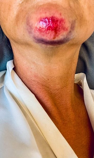 onnettomuus noora karma (1)