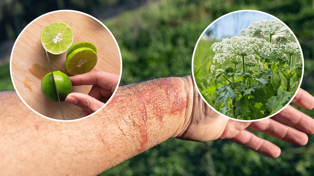 Fytofotodermatiitti-reaktio syntyy tiettyjen kasvien nesteen ja auringon UV-säteilyn seurauksena.